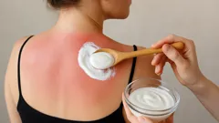My grandmother’s sunburn fix offers fast relief: «Fifteen minutes, real comfort»